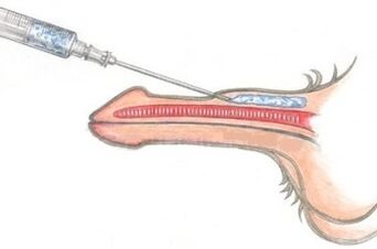 Опасен метод за уголемяване на пениса чрез инжектиране на вазелин